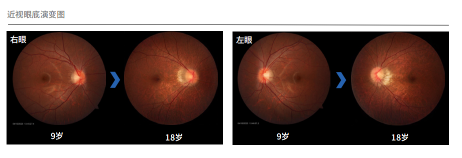 AI_慢性病早篩_鷹瞳Airdoc_愛康集團-7